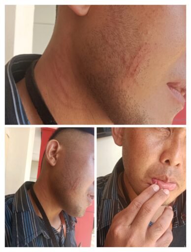 Seorang Jurnalis Batam (NZ) Dikeroyok Saat Bertugas Di Wil.Nongsa, Polri Diminta Bertindak Cepat